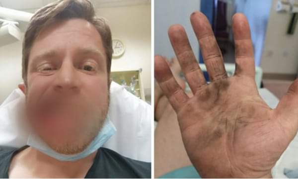 I shpërthen cigarja elektronike në gojë, 39-vjeçari humb 7 dhëmbë