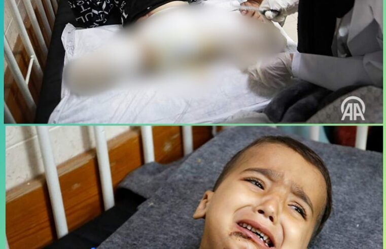 Vogëlushi 3-vjeçar nga Gaza u mbijetoi tri sulmeve izraelite, por i amputohen të dy këmbët